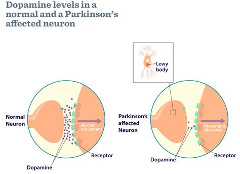 what causes parkinson's disease dopamine